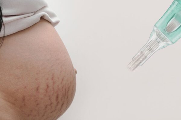 Microneedling for Stretch Marks