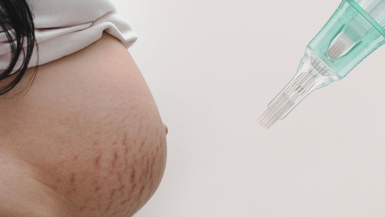 Microneedling for Stretch Marks